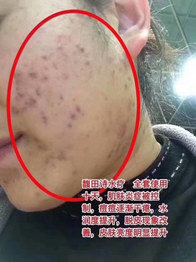 馥田詩水療，全套使用十天，肌膚炎癥被控制，痘痘逐漸干癟，水潤度提升，脫皮現象改善，皮膚亮度明顯提升。